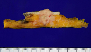 남성 유방암 수술 후 육안 소견: 유륜 하(젖꽃판 밑) 종괴