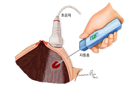 초음파 유도하 자동총 중심생검 - 초음파, 자동총