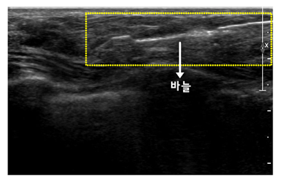 맘모톰 조직검사 시술 사진