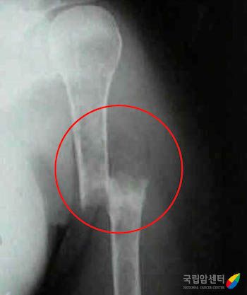다발골수종 환자에서 발생한 위팔뼈의 골절(X ray)