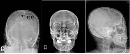 다발성골수종 환자의 두개골 X선