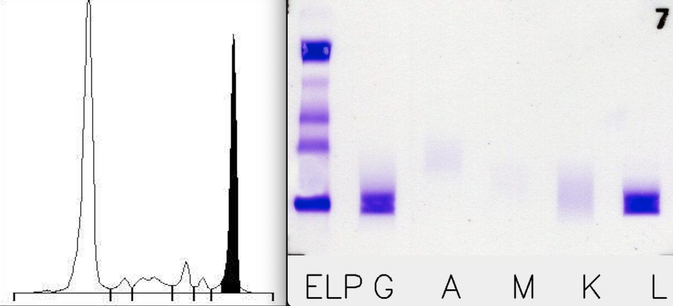 M 단백 검출을 위한 전기영동검사