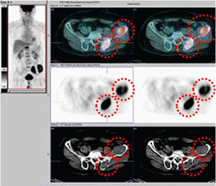다발성골수종 환자의 양전자방출단층촬영 ( PET )