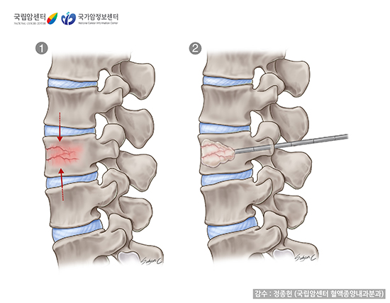 경피적척추성형술(vertebroplasty)