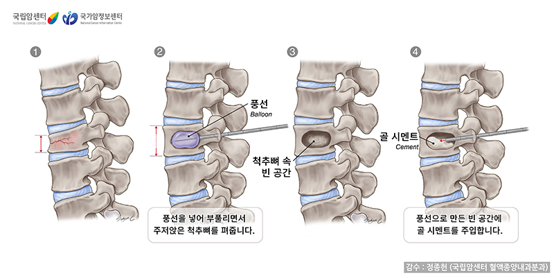 경피적풍선척추성형술(kyphoplasty)