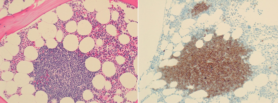 만성림프구백혈병으로 진단된 환자의 골수검사소견, B세포 CD20항원에 대한 염색소견