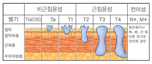 방광암의 진행단계 - 병기, 점박, 점막하층, 근육층, 주위지방층, 비근침윤성(CIS, Ta, T1), 근침윤성(T2, T3, T4), 전이성(N+, M+) 림프절이나 뼈, 폐, 간 등 다른 장기로 전이된 경우