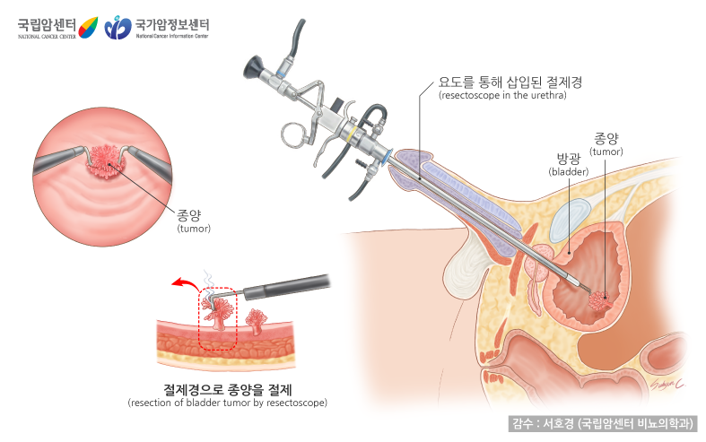 방광암-경요도적방광종양절제술
