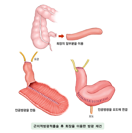 근치적방광적출술 후 회장을 이용한 방광 재건 - 회장의 일부분을 이용, 인공방광을 만듬, 인공 방광을 요도에 연결