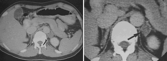 부신 종물에 대한 전산화단층촬영