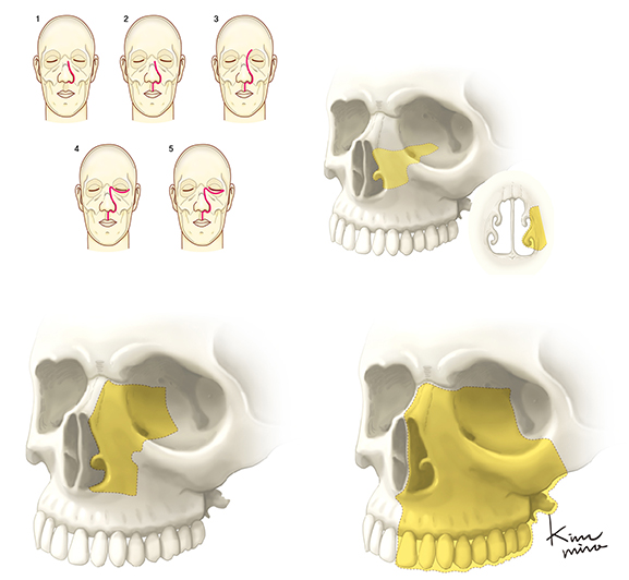 비부비동암 수술