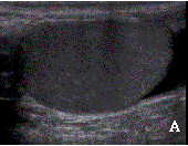 우측고환의 초음파 사진