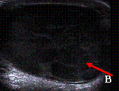 좌측 고환의 초음파 사진