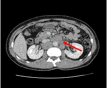 고환암의 전이로 인한 대동맥과 대정맥 주위의 후복막림프절의 종대가 관찰되는 CT 소견