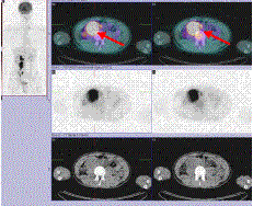 CT에서 보이는 커져 있는 후복막림프절에 강한 신호강도가 확인되는 PET-CT scan소견