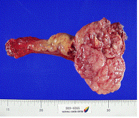 고환암의 육안소견 사진