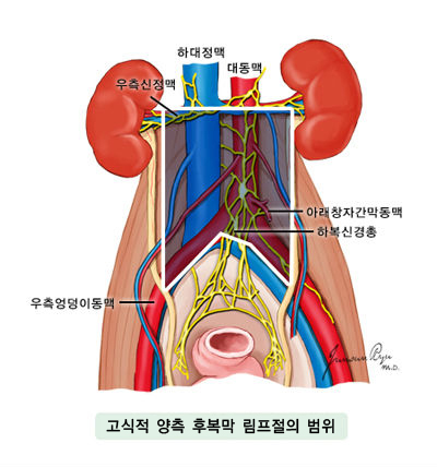 고식적 양측 후복막 림프절의 범위-하대정맥, 대동맥, 우측신정맥, 아래창자간막동맥, 하복신경총, 우측엉덩이동맥