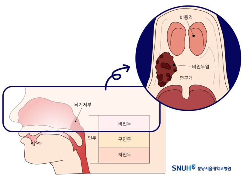 비인두의 위치와 발생하는 종양