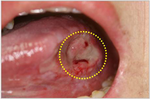 좌측 설암 병변