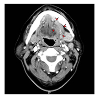 [좌측 설암 전산화단층촬영 이미지]