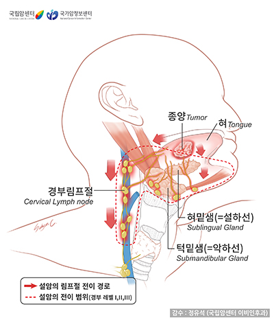 설암의 경부림프절 전이
