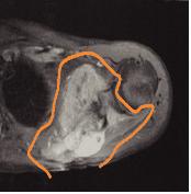 악성 골종양의 자기 공명영상 사진