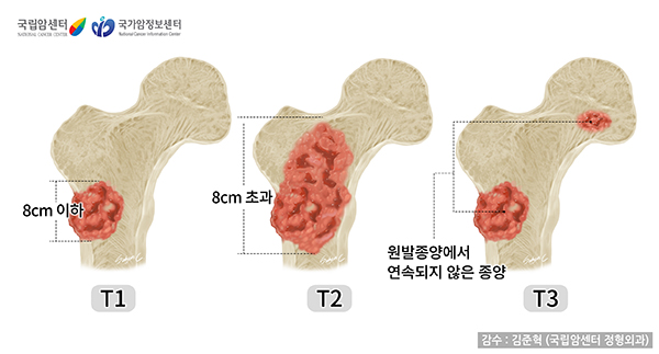 악성골종양의 병기-T병기
