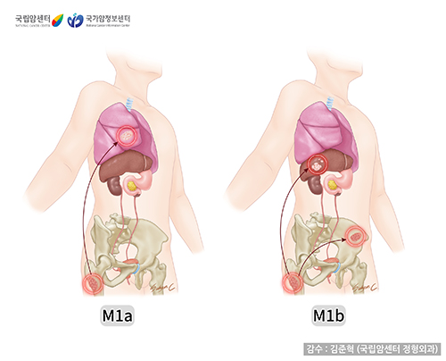 악성골종양의 병기-M병기
