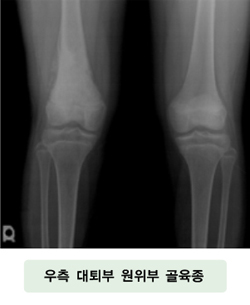 우측 대퇴골 원위부 골육종