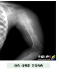 좌측 상완골 유잉육종