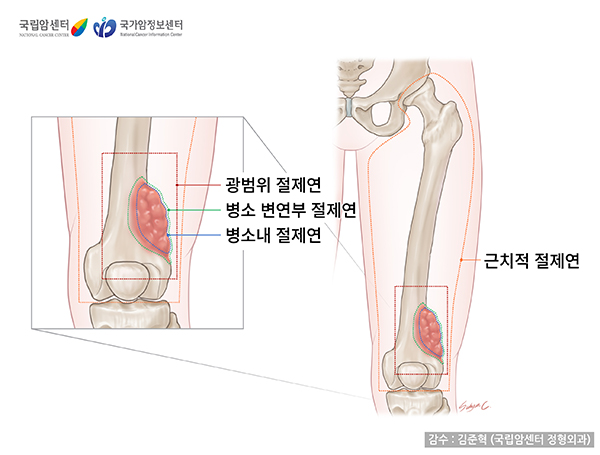 종양에 따른 절제 범위