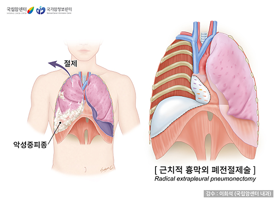 근치적 흉막외 폐전절제술