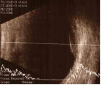 안구 초음파 소견