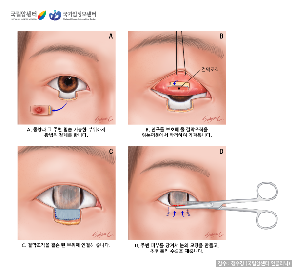 눈꺼풀 종양 제거 및 눈꺼풀 재건술