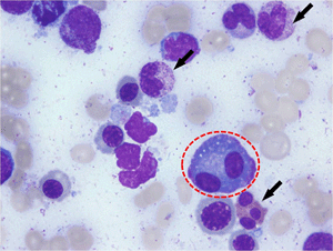 골수이형성증후군으로 진단된 환자의 골수검사 소견