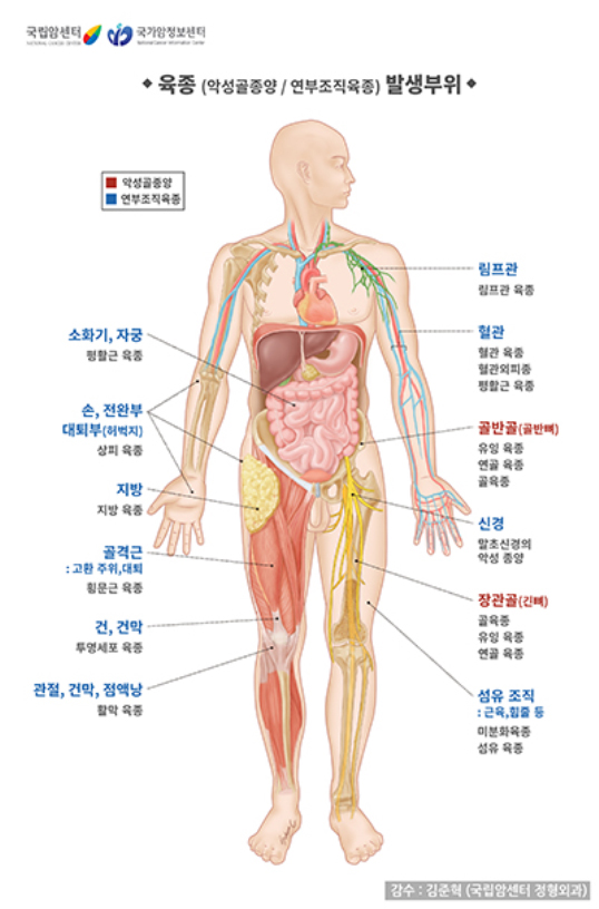 육종 발생부위
