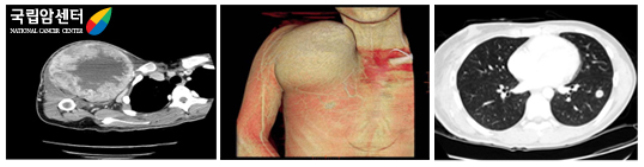 오른쪽 견관절 주위 육종의 전산화단층촬영, 같은 환자의 좌측 폐전이 CT