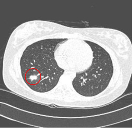 슬부에 발생한 활막육종(synovial sarcoma)환자에서 시행한 흉부 CT소견상 우측 폐 하엽으로의 전이소견이 관찰됨