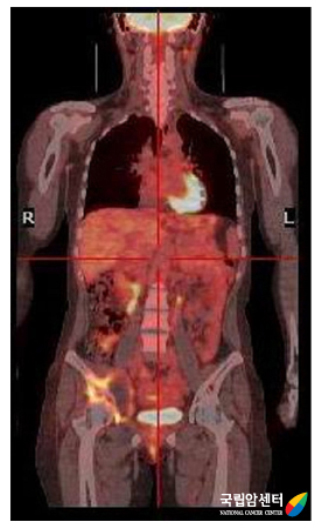 양전자방출단층촬영