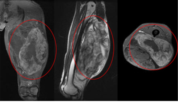 대퇴부에 발생한 악성 섬유성 조직구종(Malignant fibrous histiocytoma) 환자의 관상면, 시상면, 축면 MRI소견