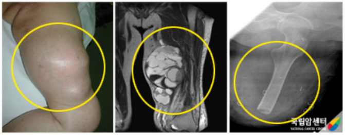 왼쪽 대퇴부의 악성말초신경초종 환자의 절단술 전후 사진