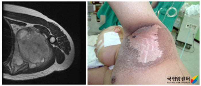 좌측 액와부에 육종을 수술 전 방사선 치료 후 수술적 절제를 위한 모습