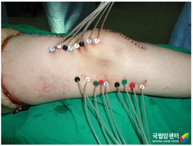 광범위 육종 절제 후 수술을 끝내기 전에 근접방사선 치료를 위한 관 삽입 모습