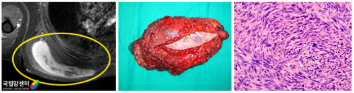 오른쪽 견갑부 주위 악성섬유성조직구종 환자의 수술적 절제술 사진