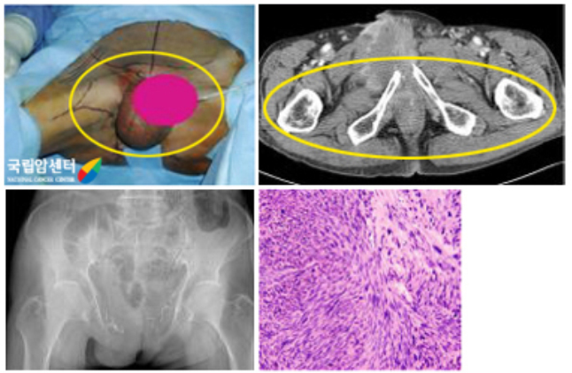 오른쪽 서혜부에 재발성 평활근 육종 환자의 사진과 광범위 절제술후 사진