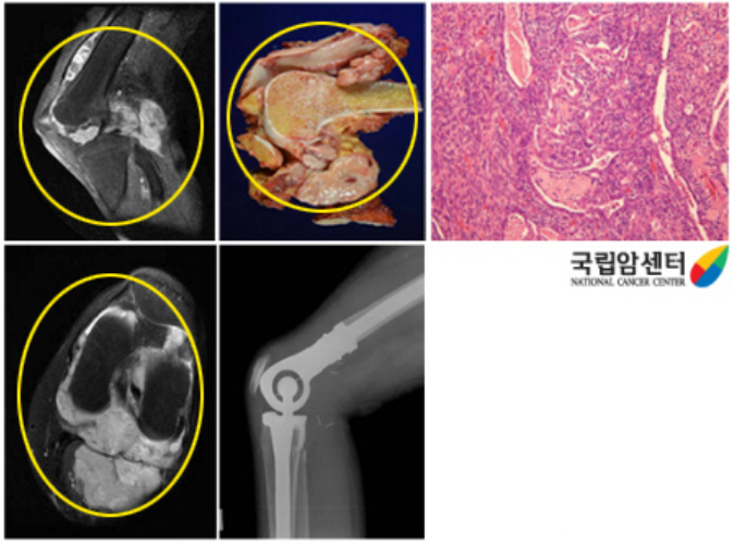 왼쪽 무릎관절 주위에 발생된 활막육종 환자의 사진