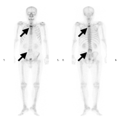 경추, 흉추, 및 요추에 다발성 골전이 병변이 관찰되는 뼈동위원소 검사