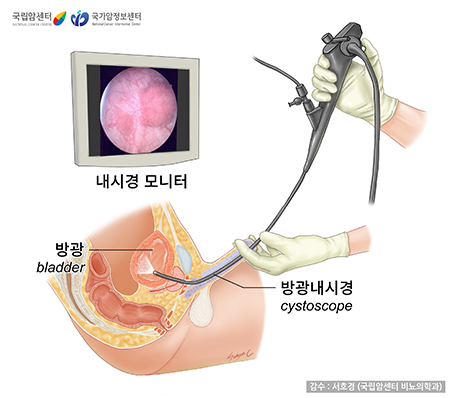 방광내시경 검사