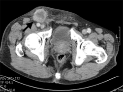 요도암 환자의 골반 컴퓨터 촬영