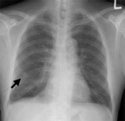 암의 전이로 의심되는 흉부 X-ray 검사
